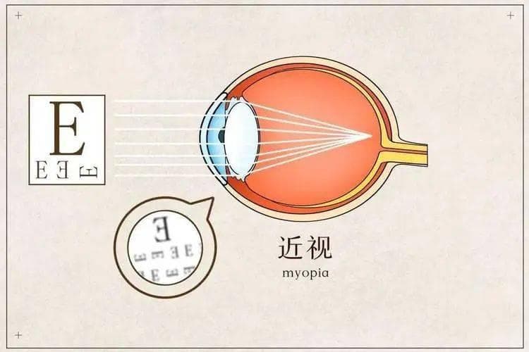 判定真假近视，最有效的方法是这个！