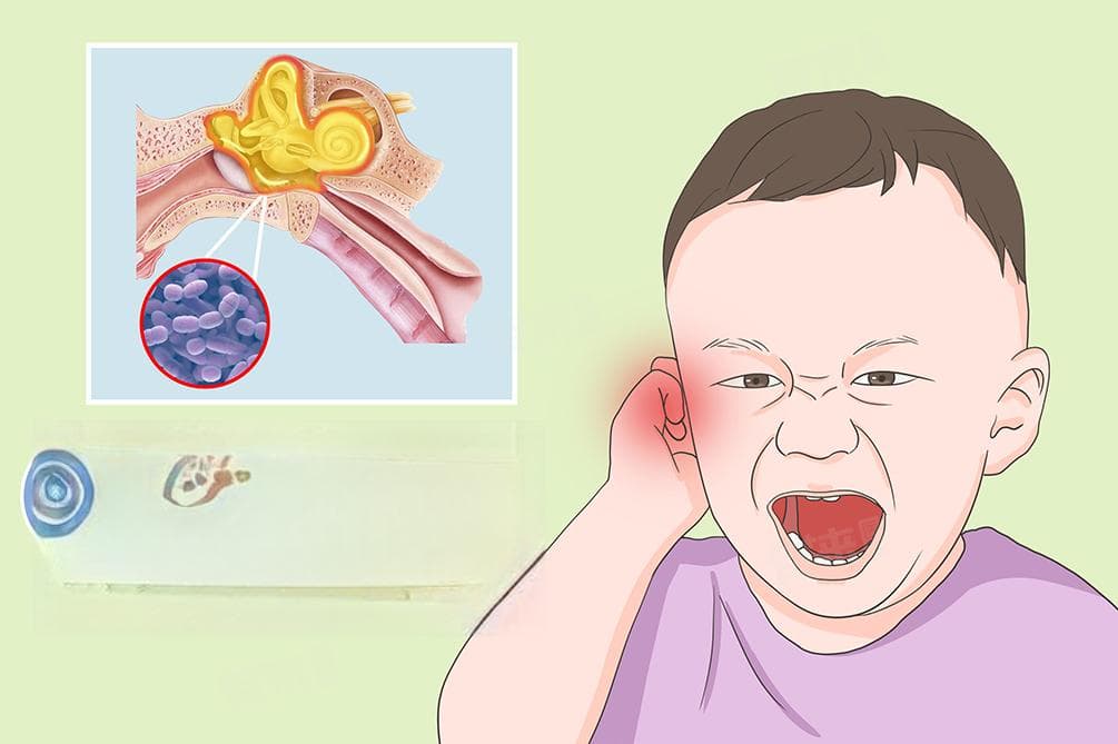 中耳炎积液如何排出