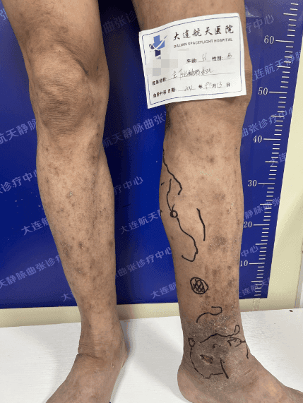 大连航天医院杨超美:下肢静脉曲张治疗宜早不宜迟