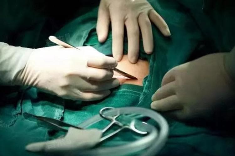 剖腹产肠粘连能自愈吗？成因、症状与预防全解析