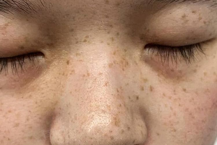 脸上黑色素怎么去除