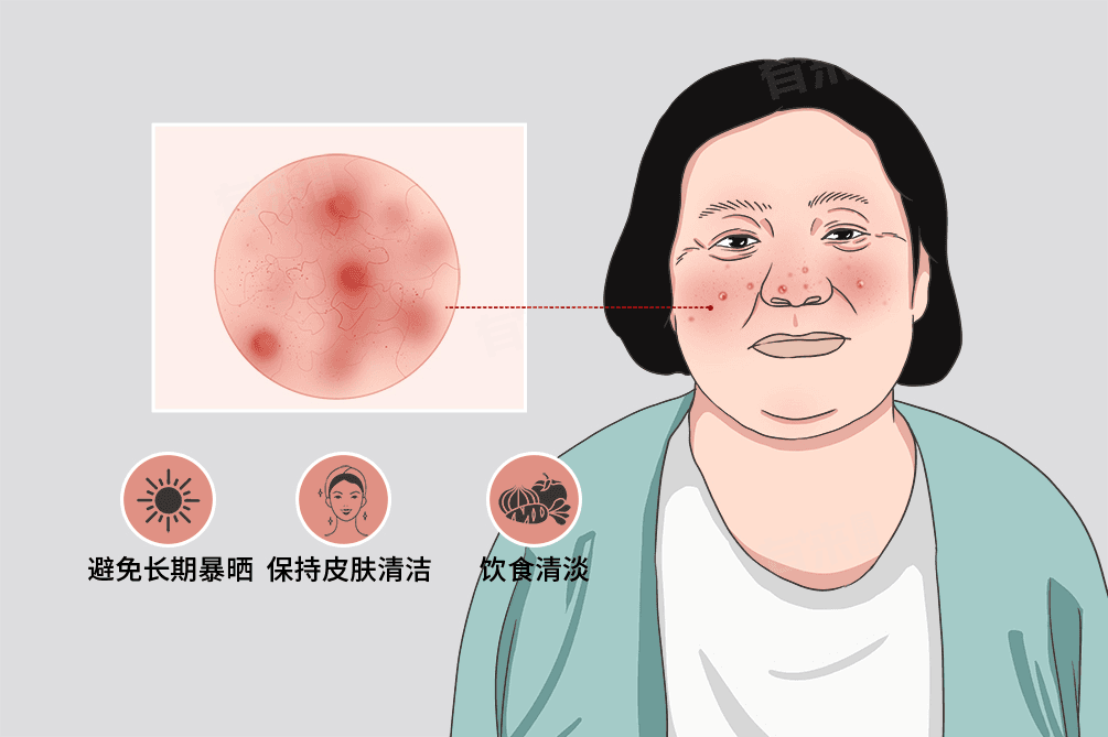玫瑰痤疮症状及日常护理要点