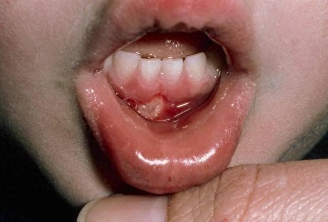 没开玩笑！大人孩子最容易得的口腔溃疡，其实是一种绝症