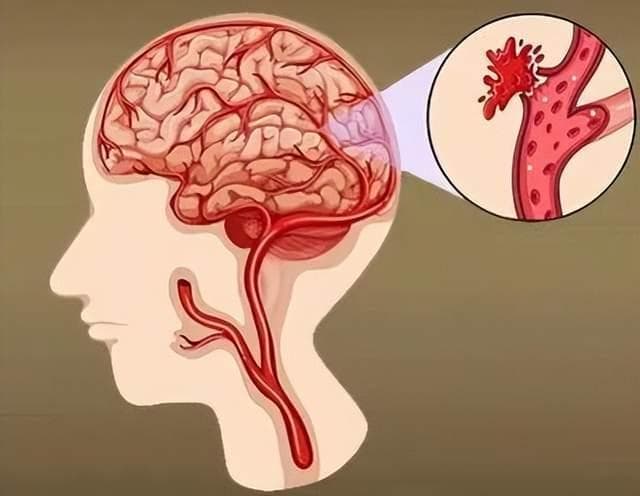 预防脑出血关键在于：控制危险因素和改善生活方式！