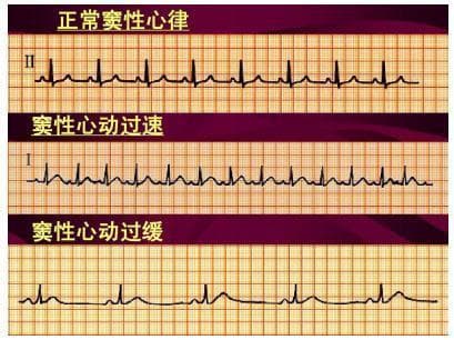 T波异常就是心梗预警吗？一文读懂T波异常的真相