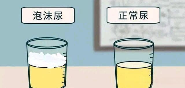 饮食调整，告别泡沫尿烦恼
