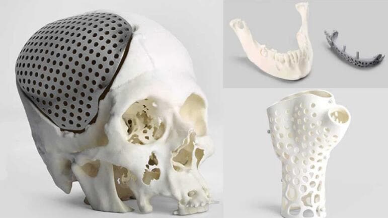 3D打印在医疗植入物领域有哪些发展？