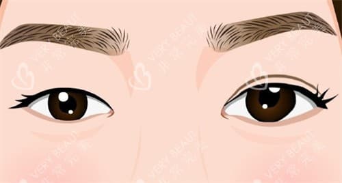 肿泡眼割双眼皮好不好看？适合做什么样的双眼皮？