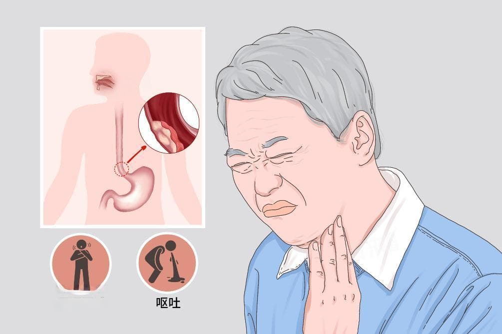 食道癌手术费用详解：从5万到20万，这些因素影响手术价格