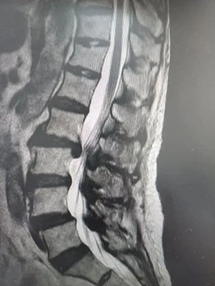 多科联合手术，成功治疗严重腰椎间盘突出症
