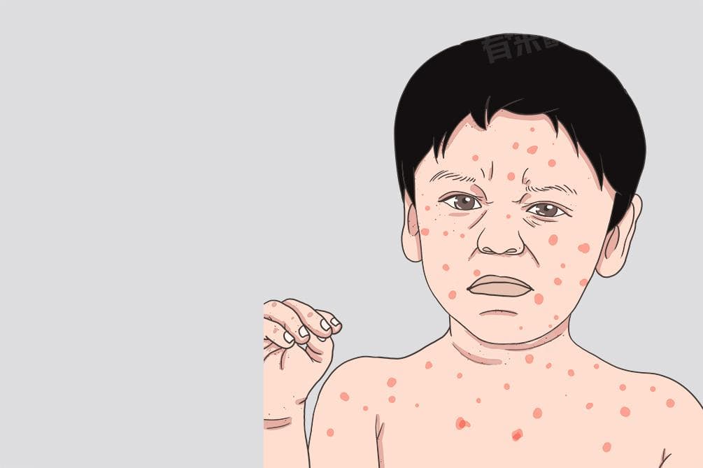 湿疹和风疹有什么区别