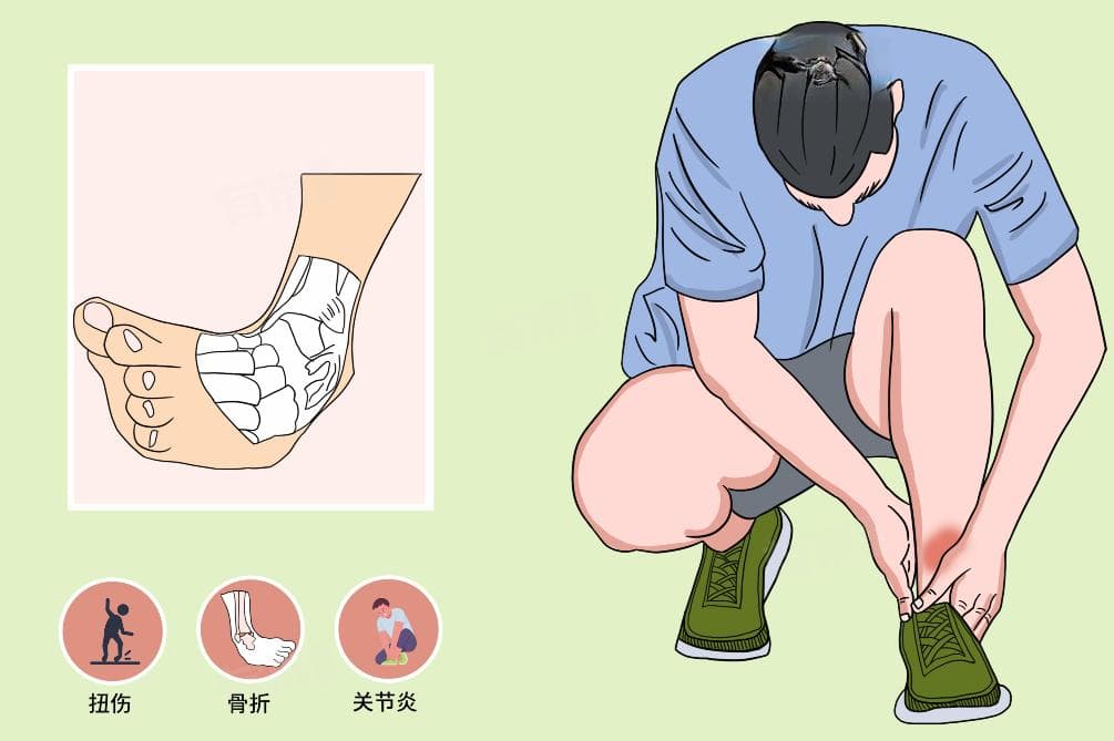 踝关节融合术后多长时间能正常走路