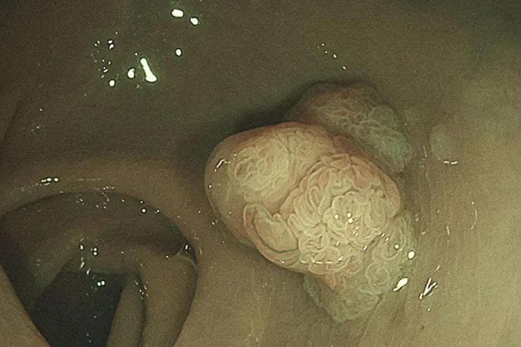 肠管状腺瘤是什么病，严重吗