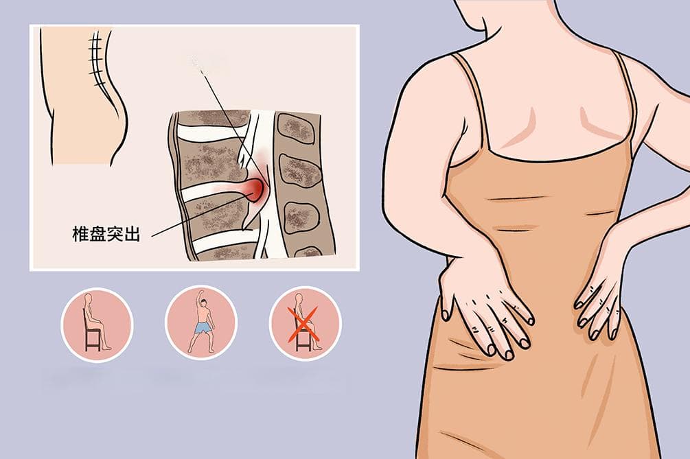 腰间盘突出8种锻炼方法