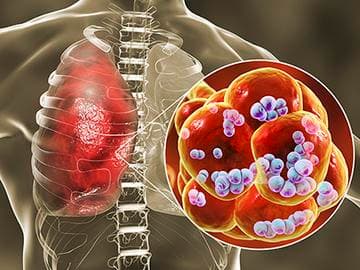 肺炎链球菌肺炎：症状、诊断与治疗全解析
