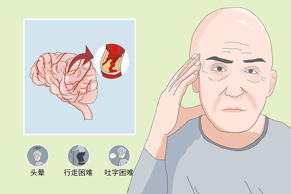 脑血管病：症状、诊断与治疗全解析