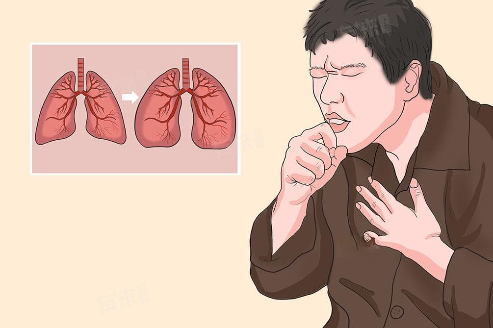 肺水肿症状及表现