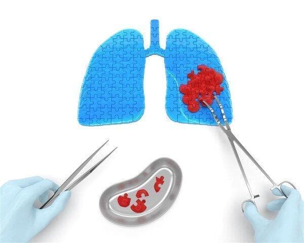 肾透明细胞癌转移肺部的靶向治疗药物全解析