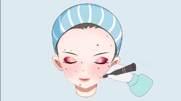 激光点痣的价格区间及影响因素解析