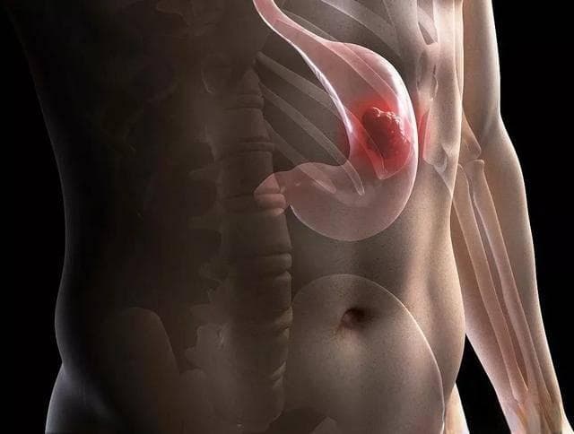 详解：『胃癌前病变、癌前疾病』—萎缩性胃炎、肠化、不典型增生