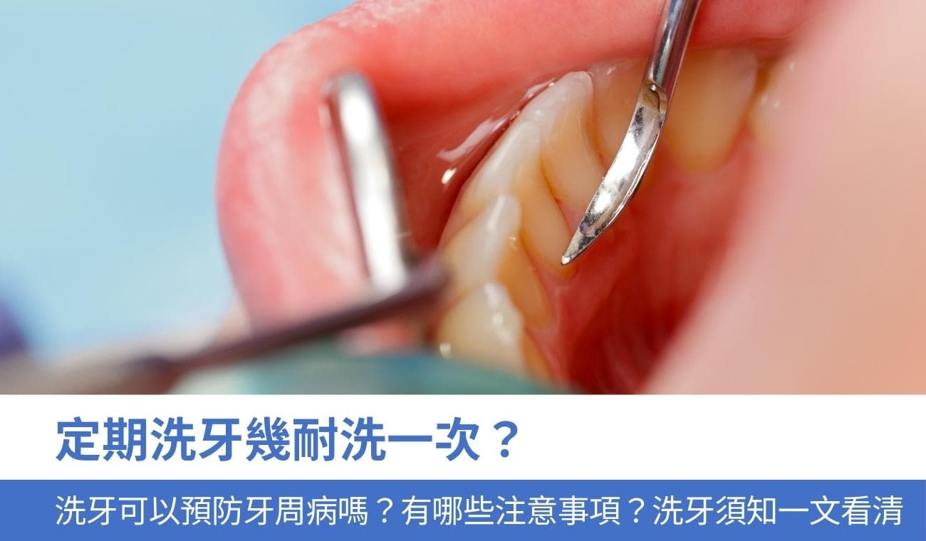 定期洗牙指南：原理、过程、注意事项全解析
