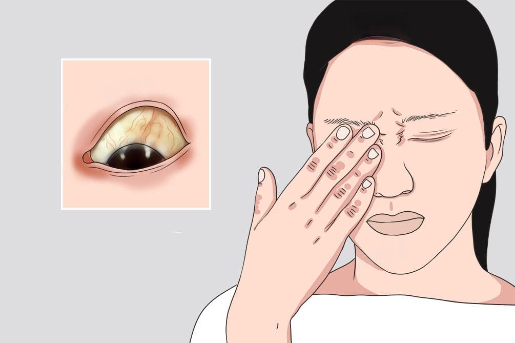 眼球发黄浑浊有血丝是怎么回事