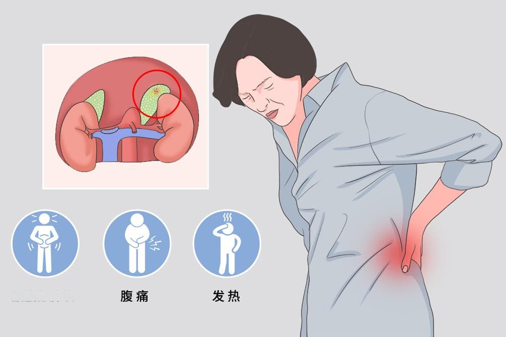 肾上腺囊肿