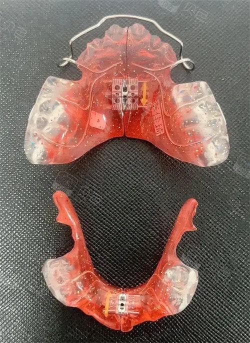 揭秘！颌垫治疗颞颌关节的原理：包括改变咬合关系、调整垂直距离、增加咀嚼功能等！