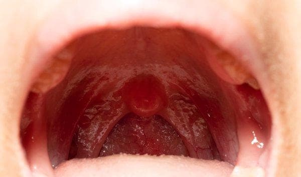 寄生虫引发的咽喉炎：症状、治疗与预防