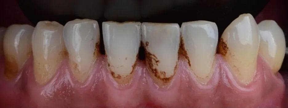 牙齿上出现小黑点别大意！只需5步，就能毁掉一口牙