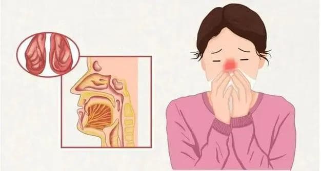 鼻炎怎么办？全面解析鼻炎的成因与治疗方法