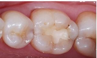 补牙选择什么材料好?3种常见补牙材料，价格和优缺点介绍