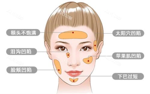 脸上做脂肪填充好不好？全方面解析面部脂肪填充的优点与风险