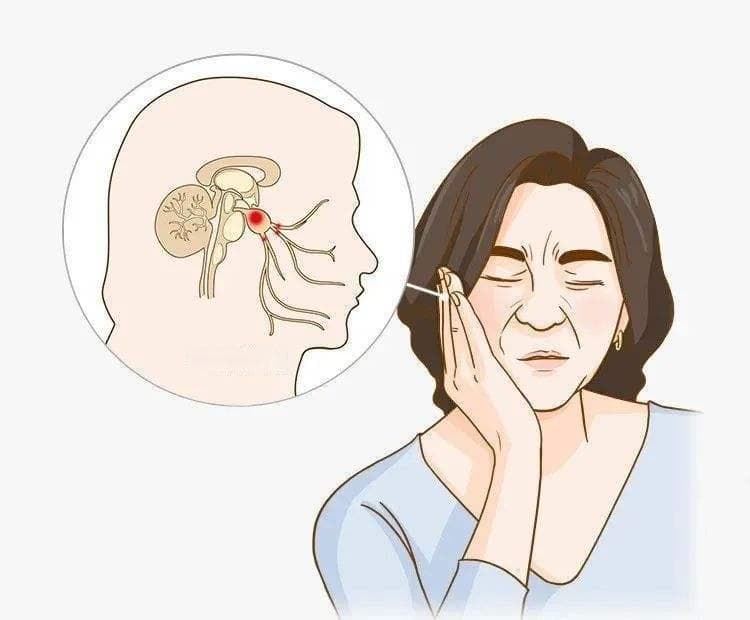三叉神经痛早期症状该如何发现？如何确诊？