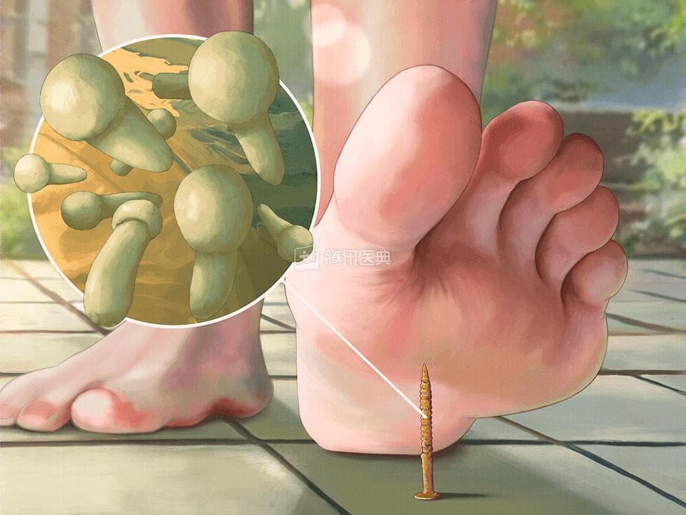 “免疫接种，健康科普” - 破伤风疫苗