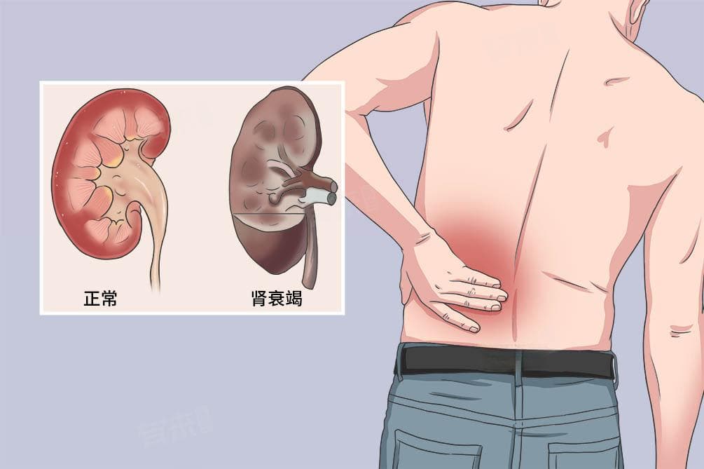 肾功能衰竭诊断标准