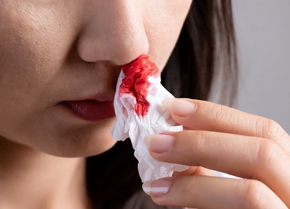 鼻出血如何处理？医生提醒：掌握这7点，让您的鼻子更安全！