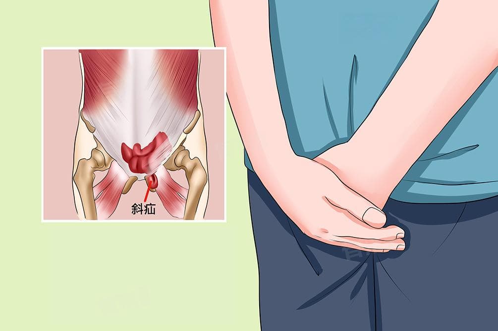 腹股沟斜疝是怎么回事