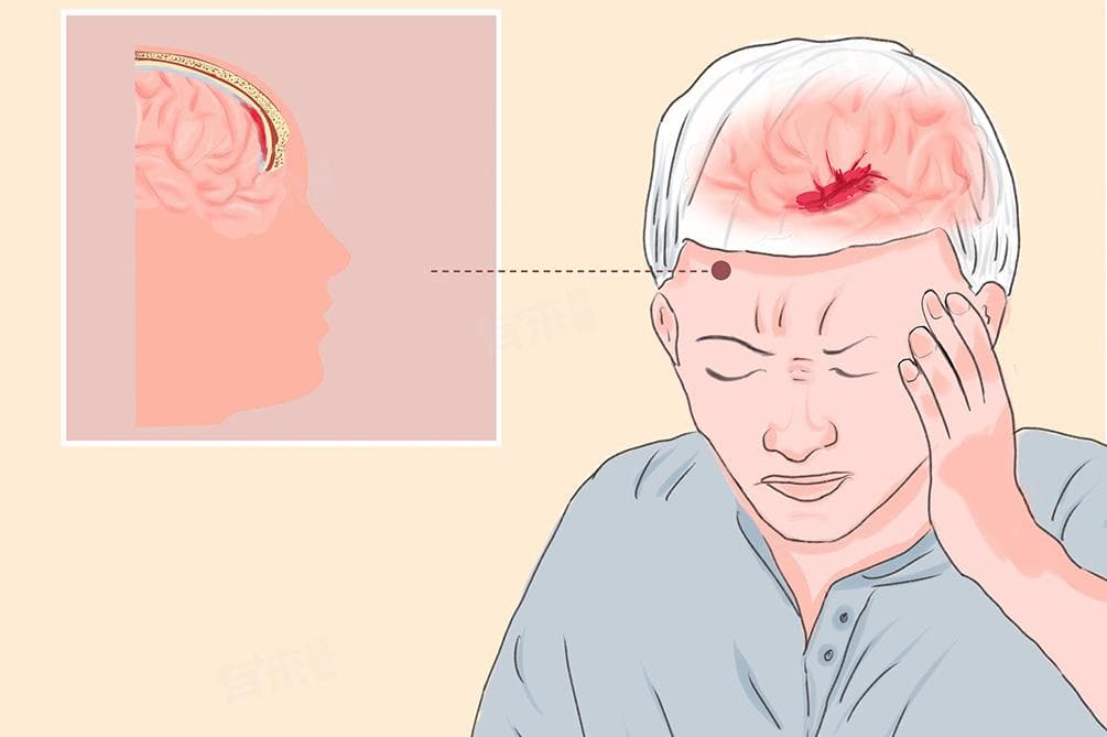 蛛网膜下腔出血的明显症状