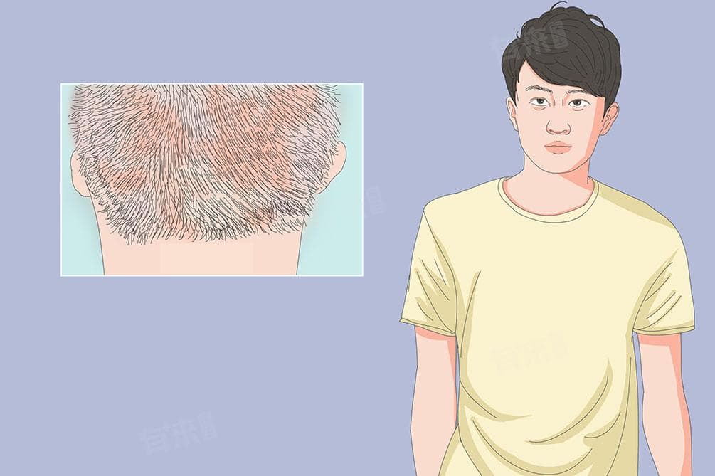 脂溢性皮炎用什么洗发水