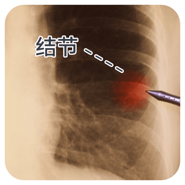 肺结节怎样调理