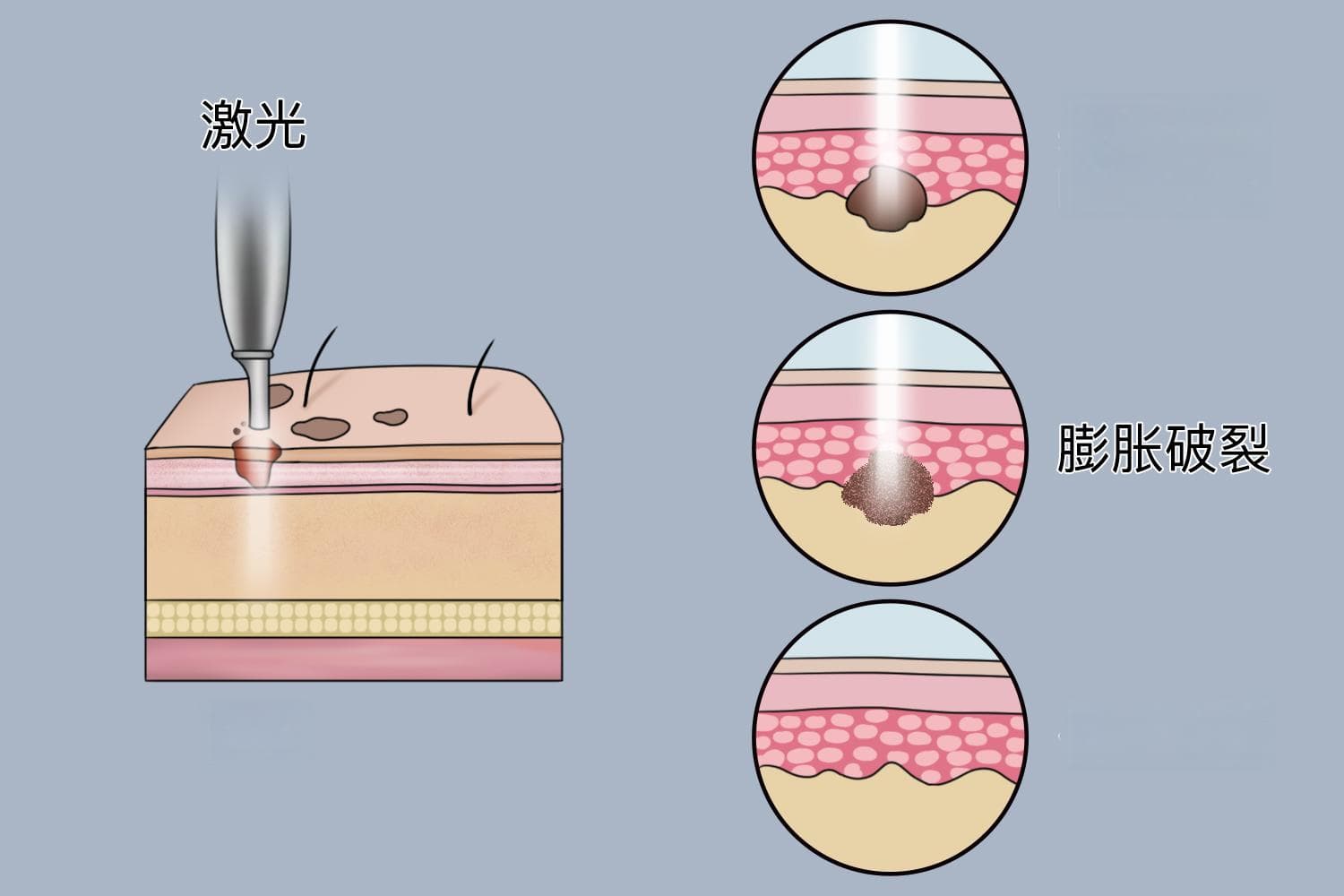 激光治疗疼吗