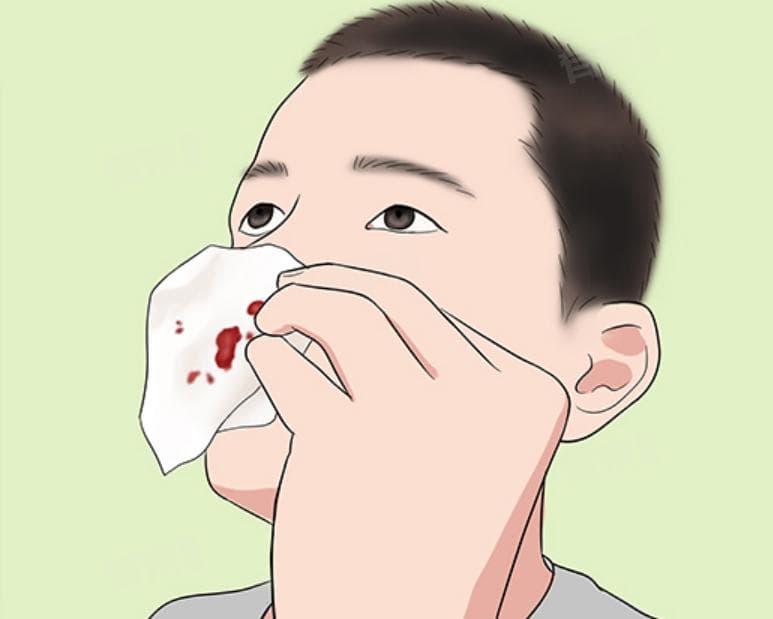 小孩流鼻血怎么办？预防和处理方法全攻略