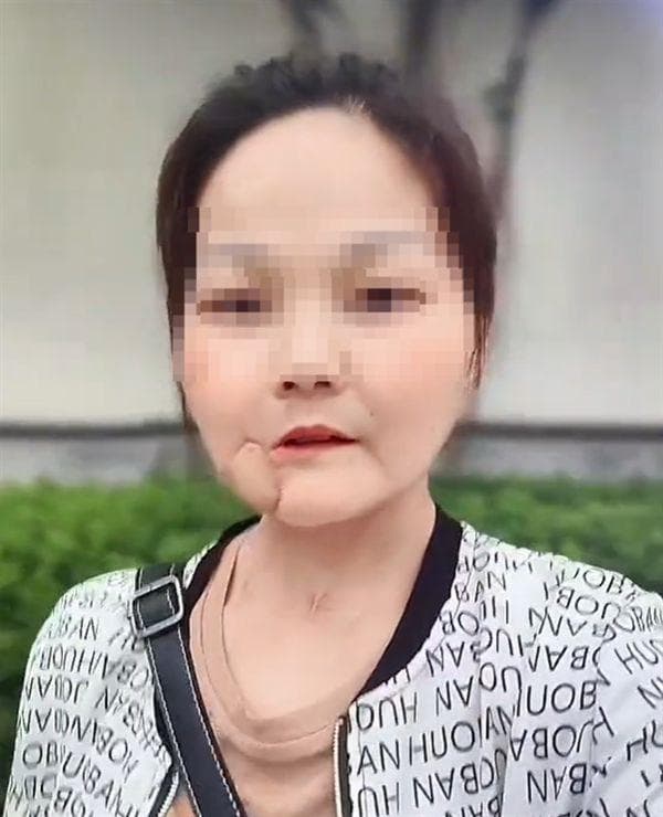 嚼槟榔10年，湖南博主“雨虹”患口腔癌离世