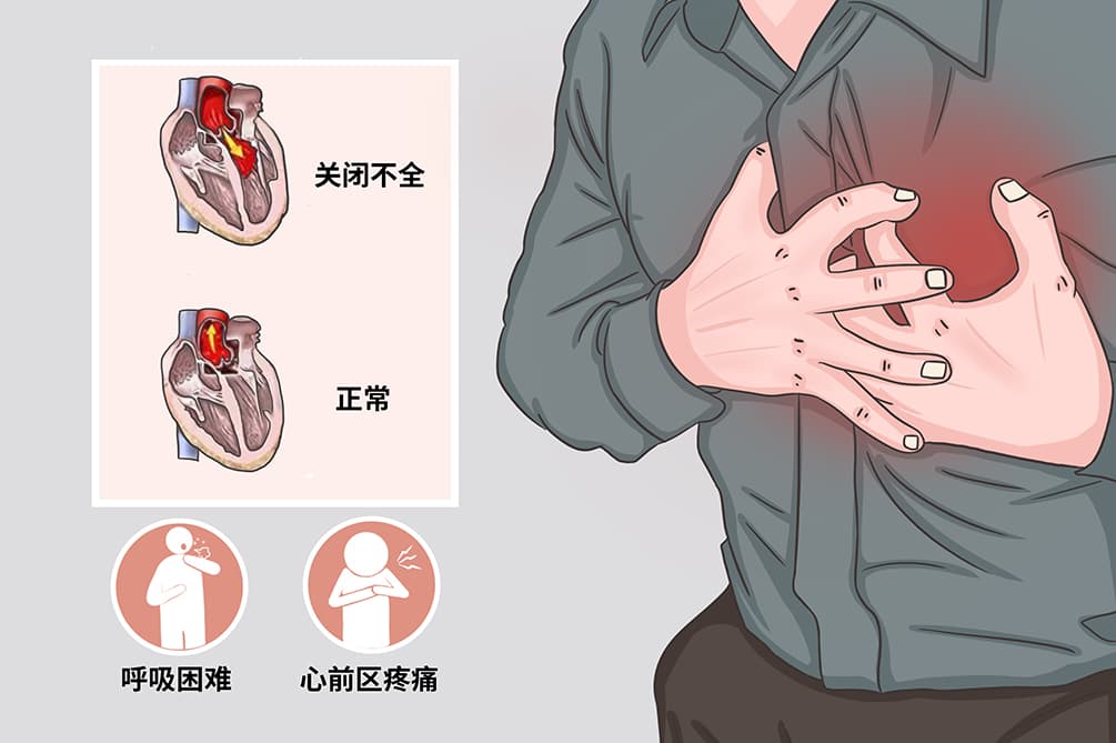 主动脉瓣关闭不全