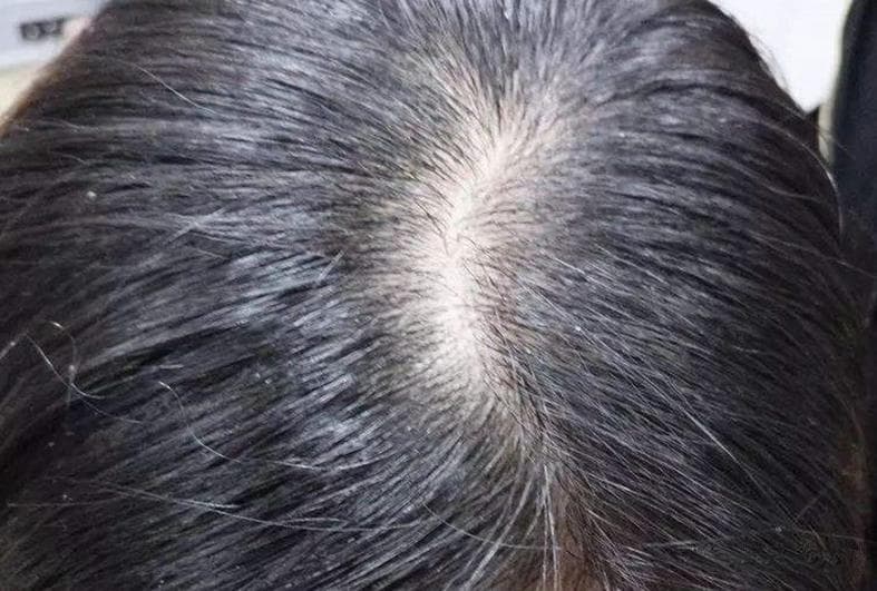 最适合你的洗头频率是什么？根据头皮类型调整护理策略！
