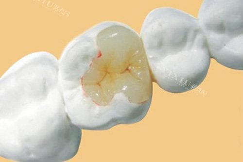 牙齿有小洞千万别补？真相揭晓！形成原因/不补牙的危害/补牙重要性一览