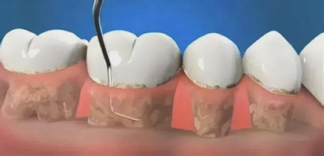 钱塘牙科爱牙科普：龈下刮治究竟有多可怕？