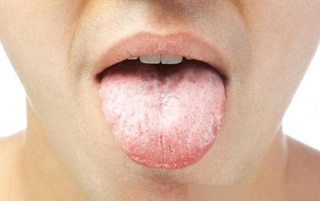 舌苔厚腻，舌中有裂纹？这种舌头别健脾，它的病根并不在脾胃