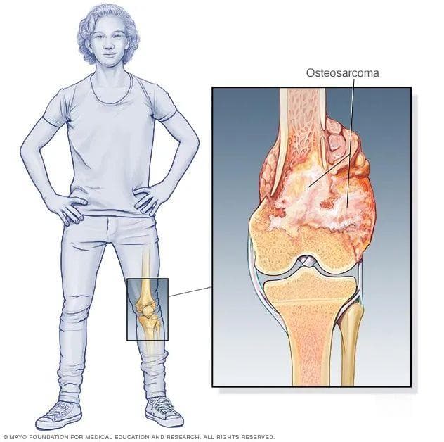 “腿疼腿无力”？当心是这种罕见且凶险的骨肿瘤！